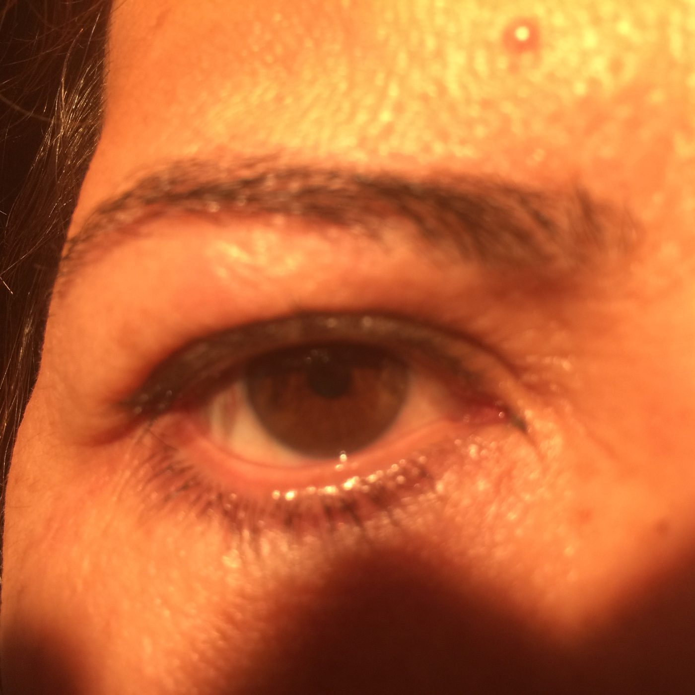 Person with a drooping eyelid learning about ptosis causes and warning signs