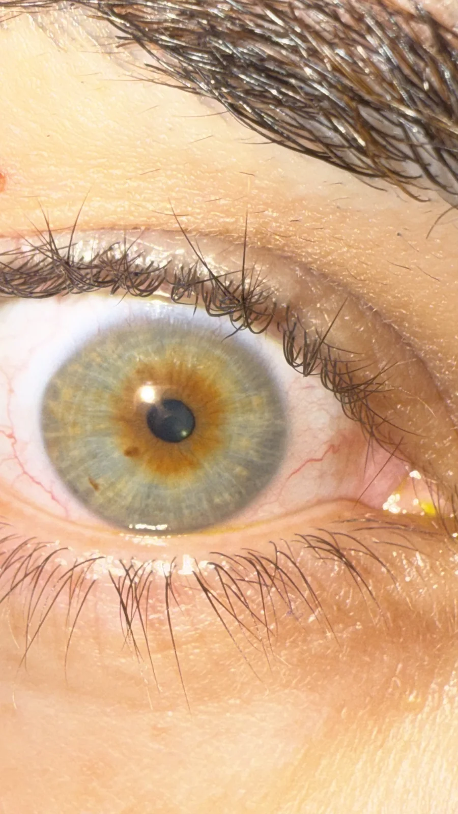 Close-up showing unequal pupil sizes associated with anisocoria