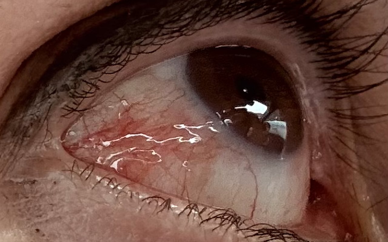 Close-up of a red, irritated eye with visible blood vessels and tearing, the kind of red eye Dr. Roxanna Gangi examines under slit lamp magnification