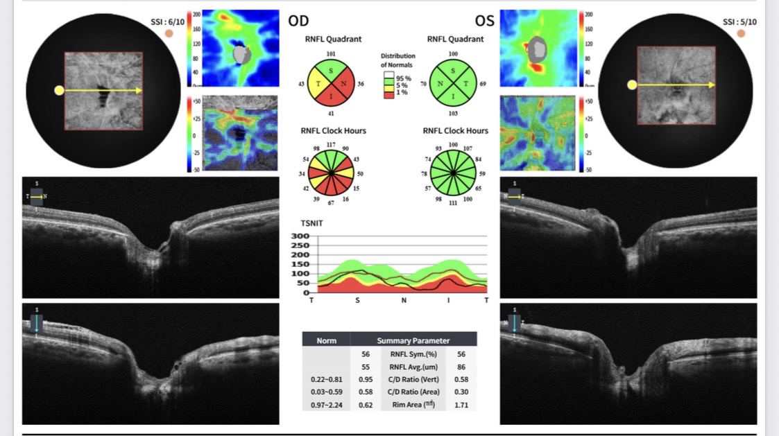 Glaucoma eye examination and vision testing by Dr. Roxanna Gangi