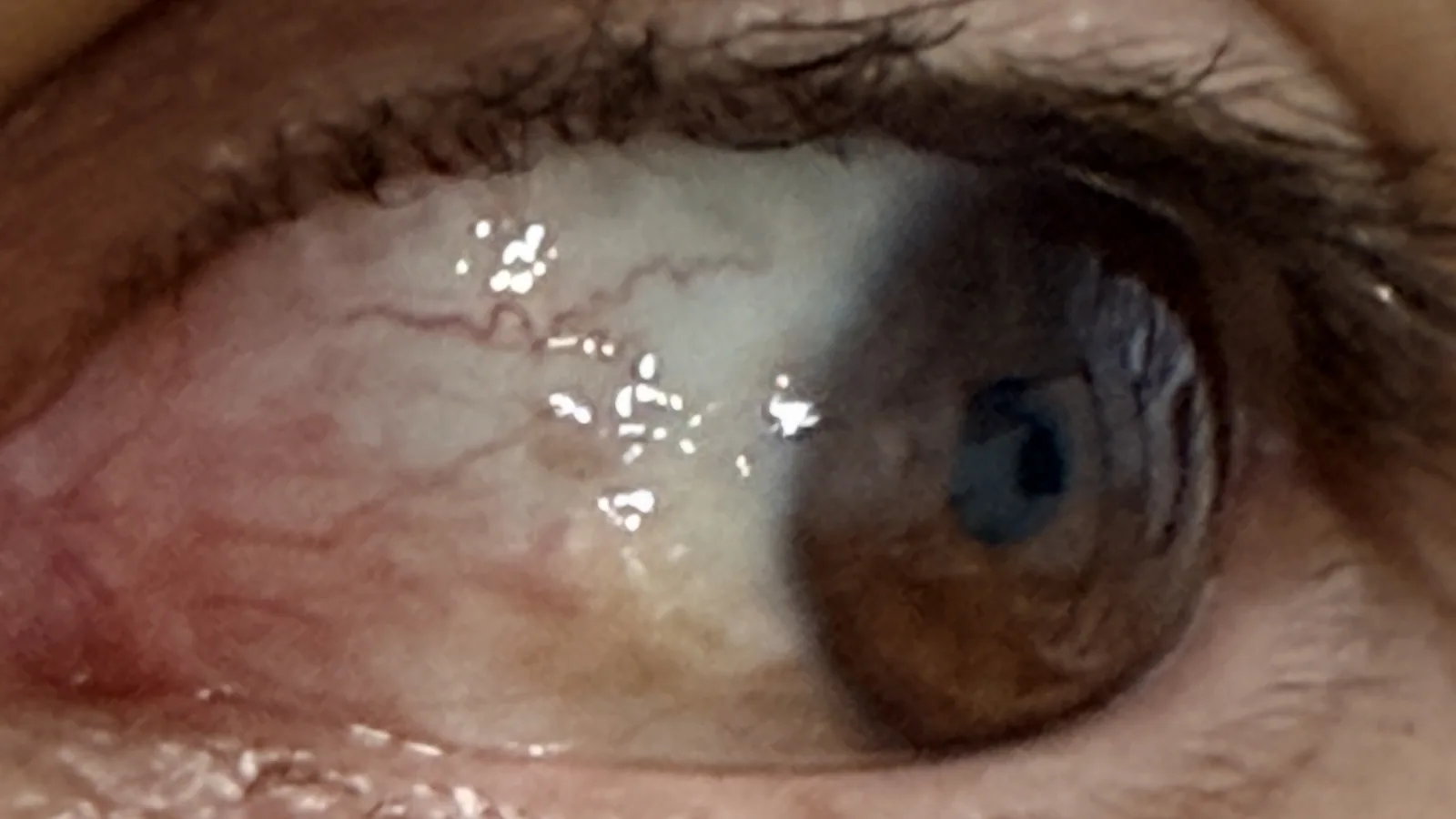 Close-up of a red, irritated eye caused by seasonal eye allergies