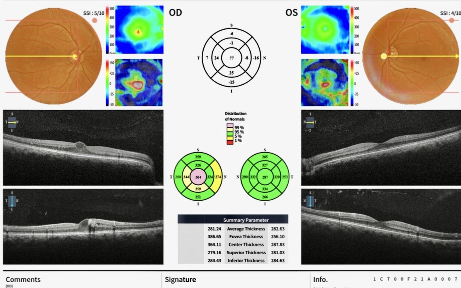 Close-up of a patient's eye during a retinal examination for flashes and floaters